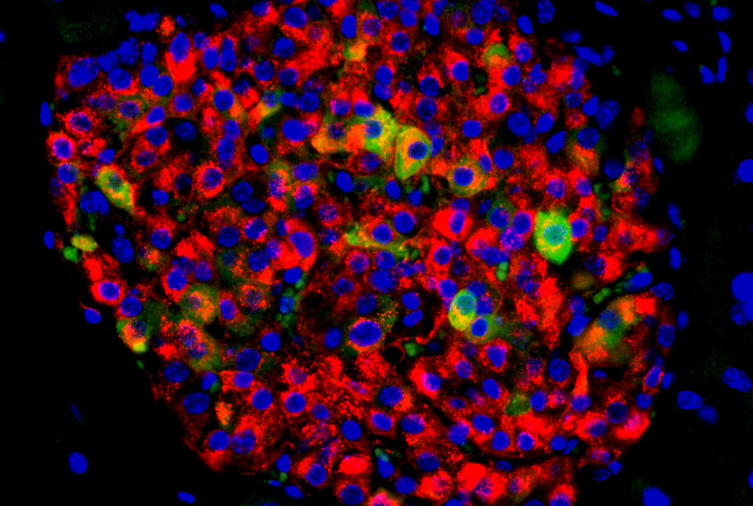 cells and diabetes